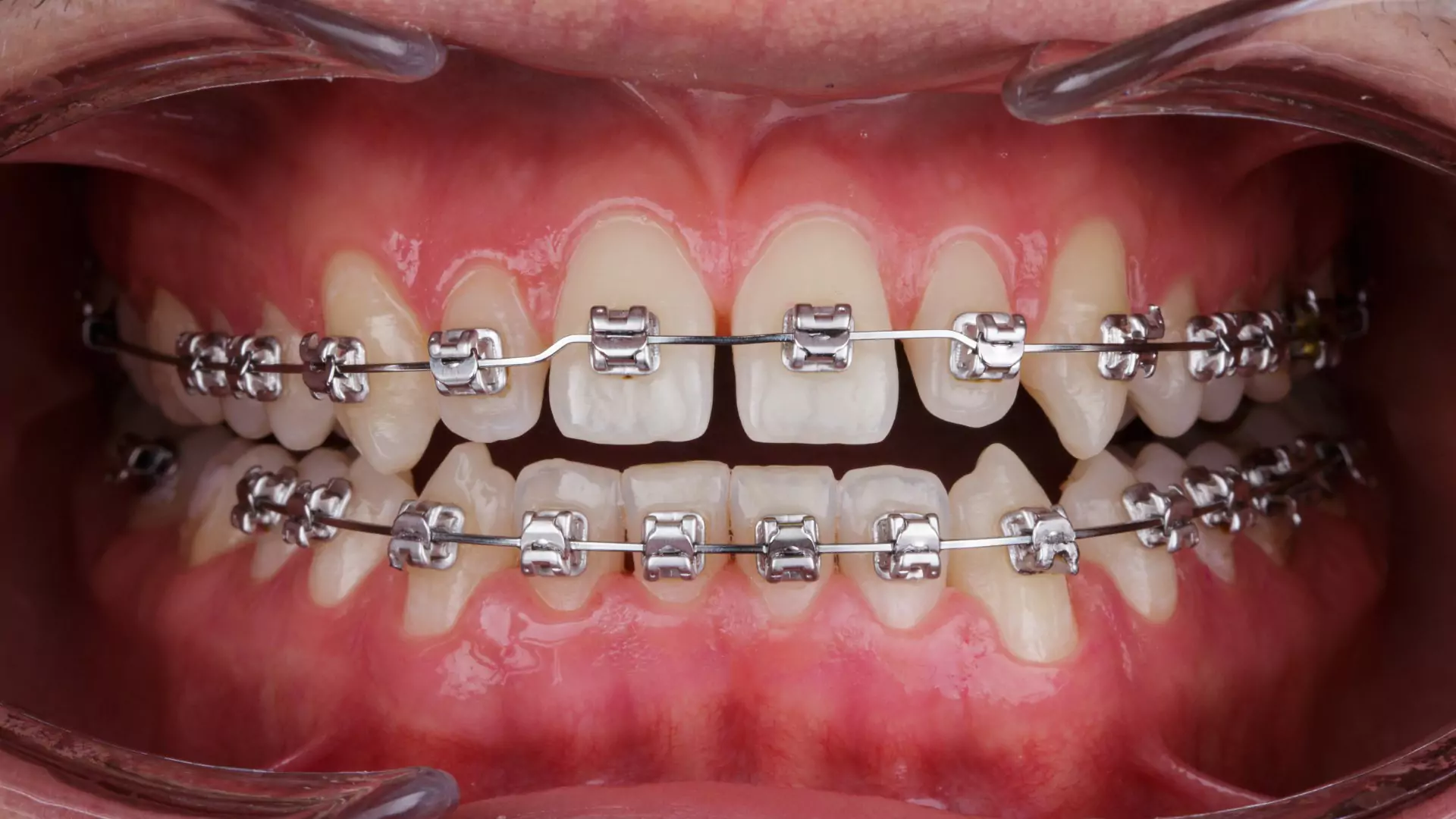 Metal and Ceramic Braces - Lucid Dental Pune