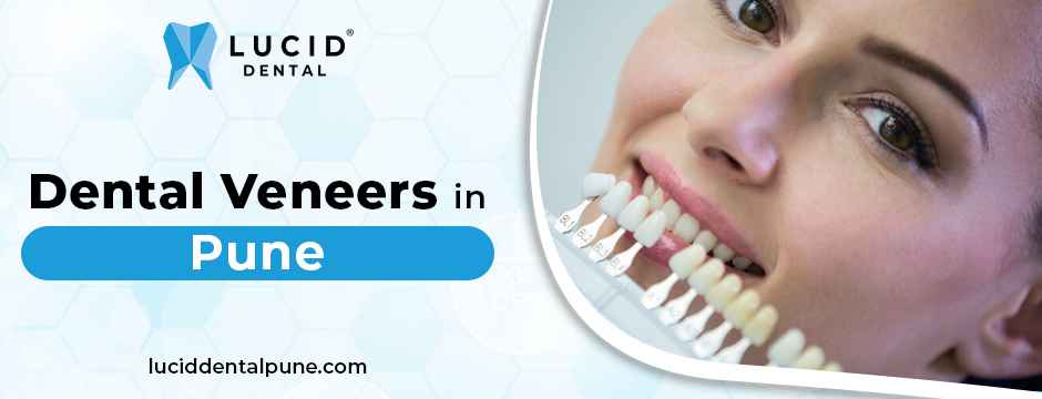 Dental Veneers in Pune