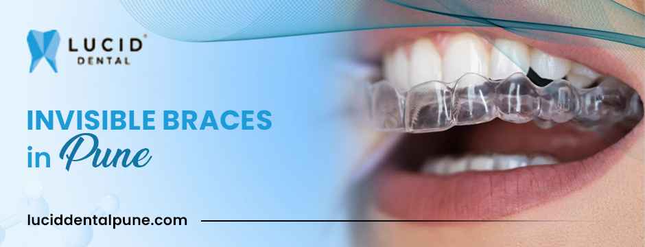 invisible braces in Pune