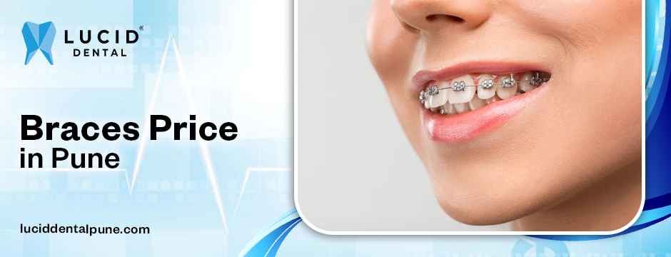braces price in Pune