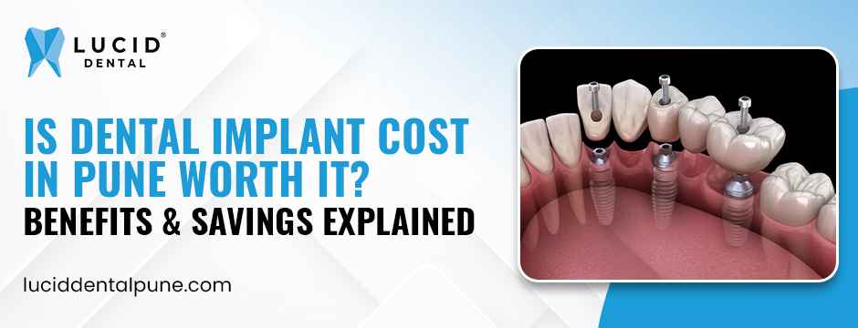 Dental Implant