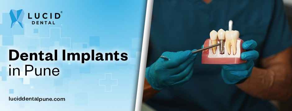 dental implants in Pune