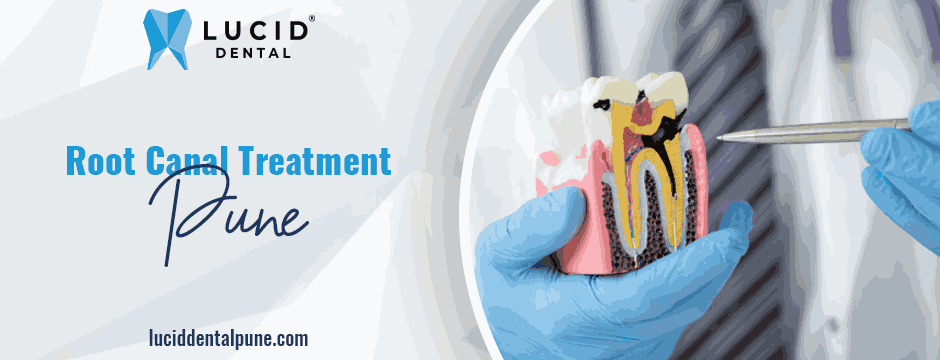 root canal treatment Pune