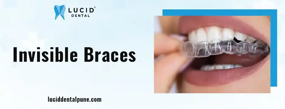 Invisible Braces