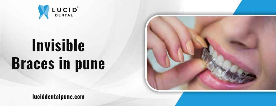 Invisible Braces In Pune