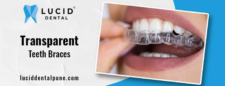 transparent teeth braces