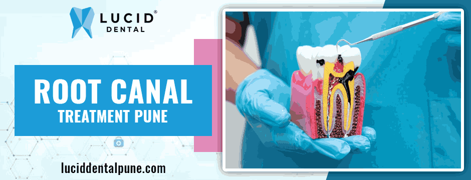 Root Canal Treatment Pune