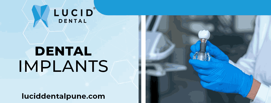 dental implants