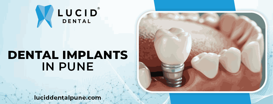 dental implants in Pune