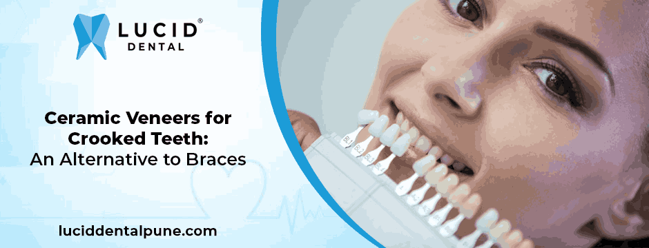 Ceramic Veneers