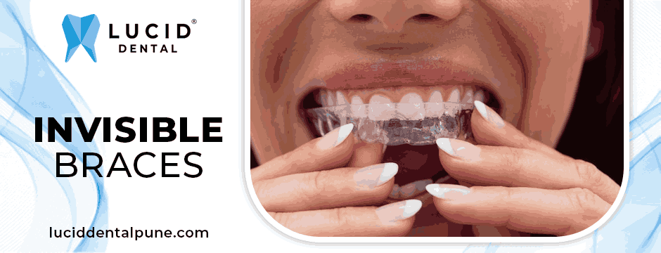 invisible braces
