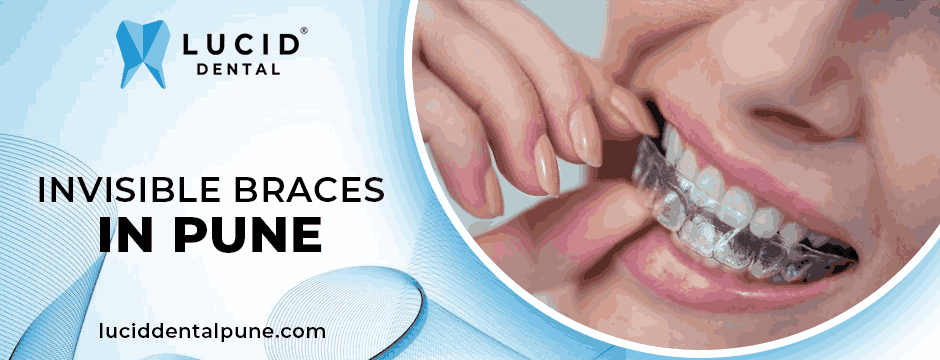 Invisible braces in Pune
