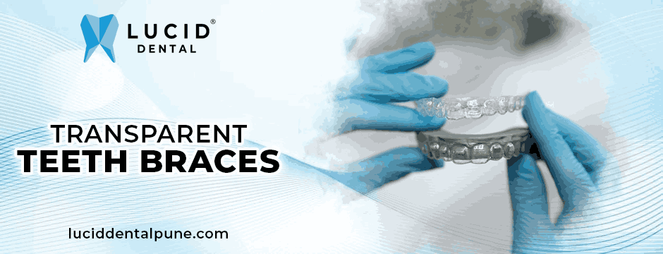 Transparent teeth braces