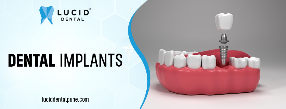 Dental Implants