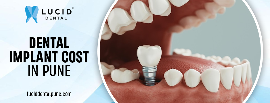Dental Implant Cost in Pune