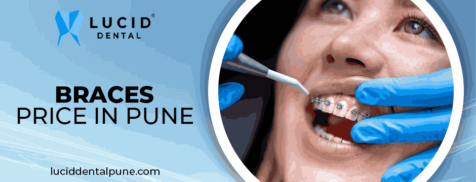braces price in pune