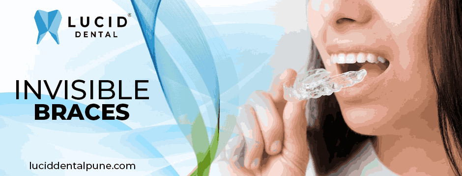 invisible braces