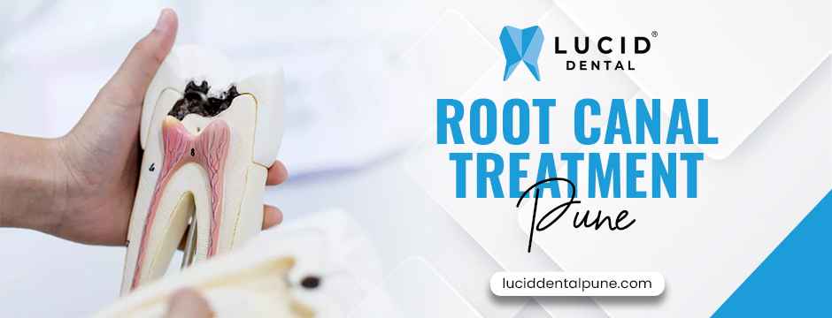 root canal treatment Pune