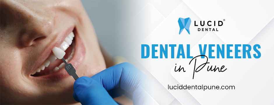 Dental Veeners in Pune