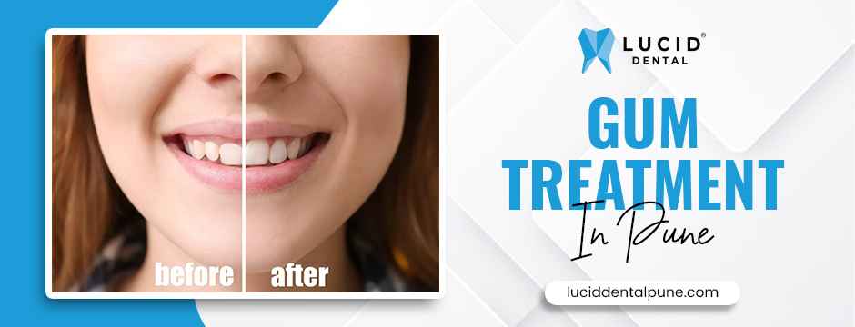 gum treatment in Pune