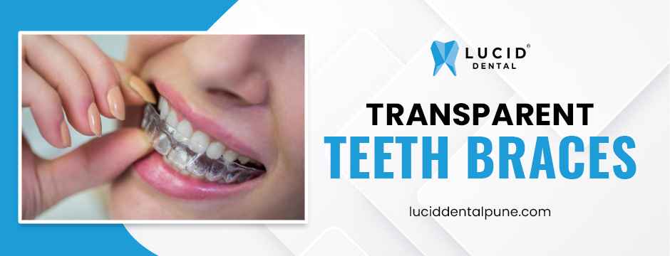 Transparent Teeth Braces