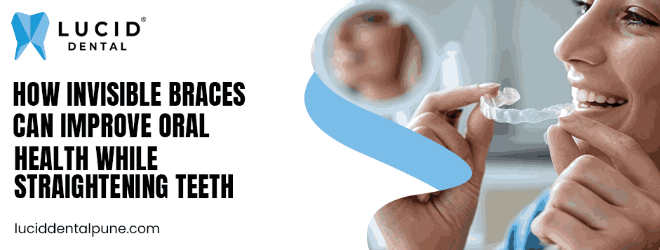 How Invisible Braces Can Improve Oral Health While Straightening Teeth