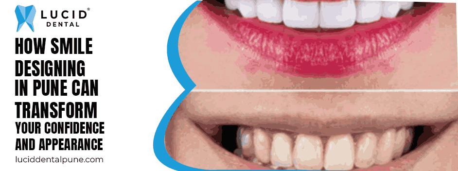 How Smile Designing in Pune Can Transform Your Confidence and Appearance