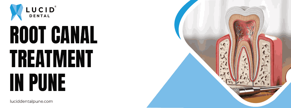 Root Canal Treatment in Pune
