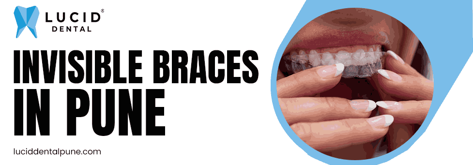 invisible braces in pune