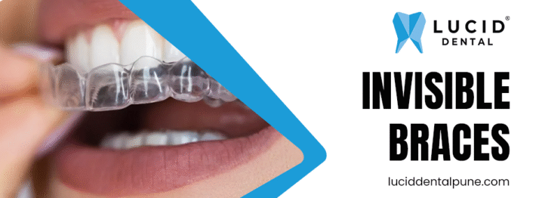 invisible braces