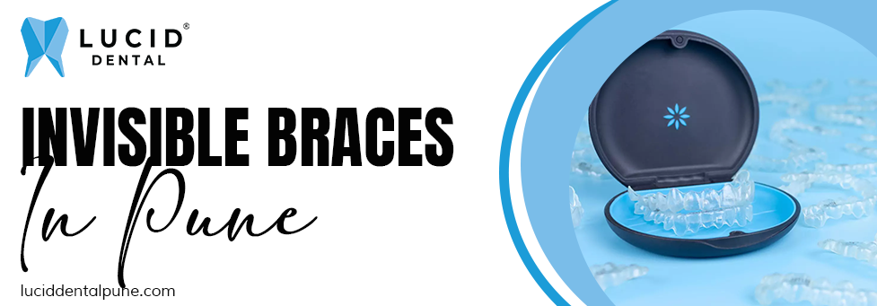 invisible braces in Pune