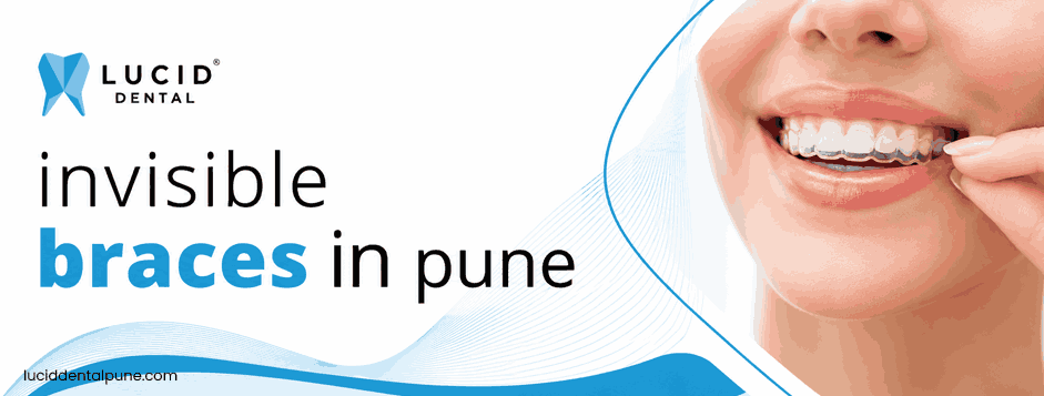 invisible braces in Pune
