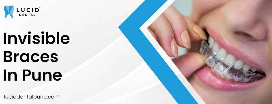 Invisible braces in Pune