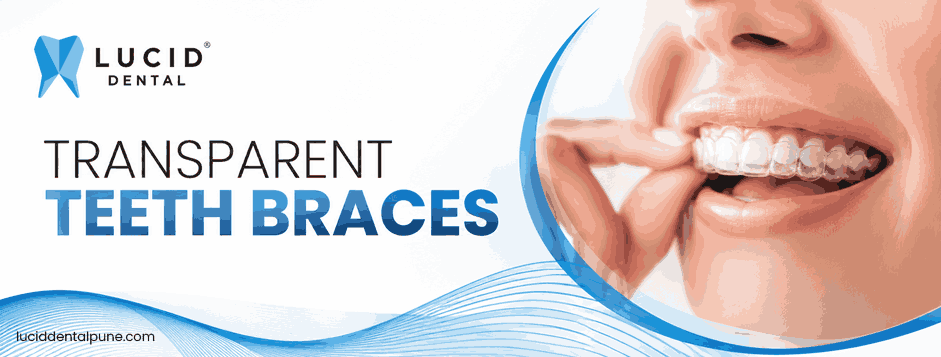 Transparent Teeth Braces