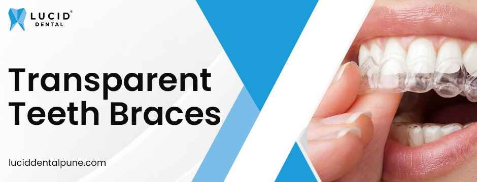 Transparent teeth braces